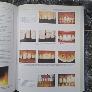 Prótesis fija estética en dientes anteriores