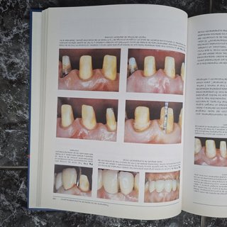 Prótesis fija estética en dientes anteriores