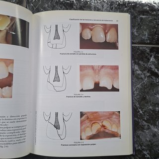 Lesiones traumáticas en odontopediatría