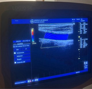 Ultrasonido GE Logiq S6
