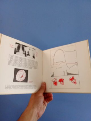 Ruidos y soplos cardíacos Valvulopatía Vinilo