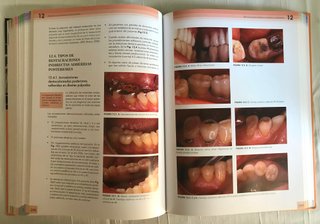 ADHESIÓN EN ODONTOLOGÍA RESTAURADORA.