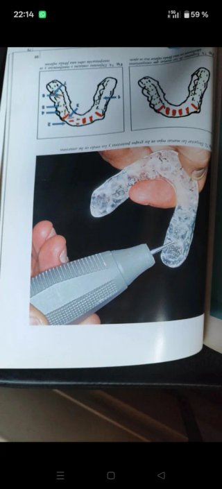 La férula oclusal técnica sistemática elaboración