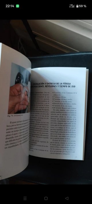 La férula oclusal técnica sistemática elaboración