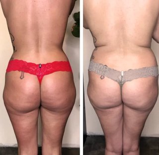 Se Realiza Terapia de Maderoterapia Profesional