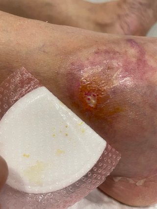 Enfermera a domicilio para cura de heridas