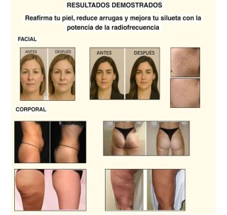 Radiofrecuencia Facial y Corporal 4 en 1