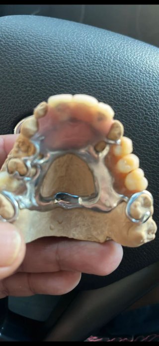 Prótesis dental  ecspernicia  17 años