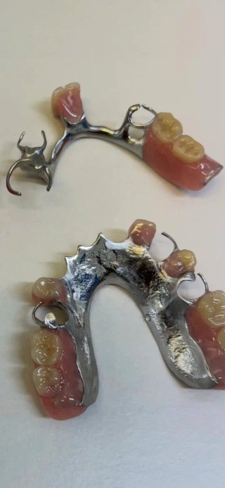 Prótesis dental  ecspernicia  17 años