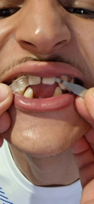 Prótesis dental  ecspernicia  17 años