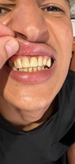 Prótesis dental  ecspernicia  17 años