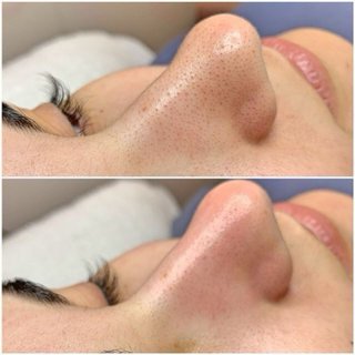 Limpieza facial profunda