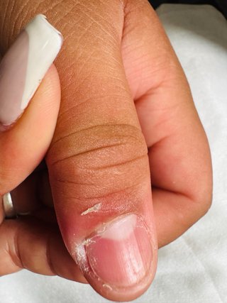 Uñas encarnadas,