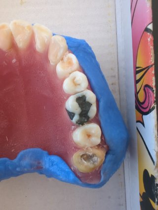 Tipodonto Dientes Naturales