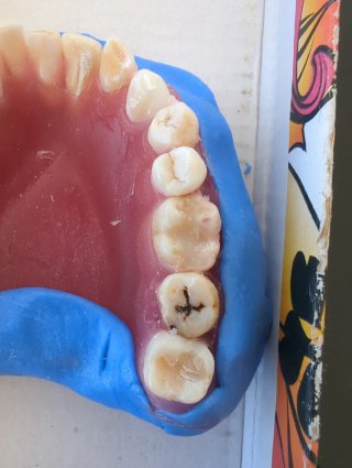 Tipodonto Dientes Naturales