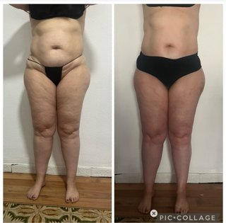 Masaje reductores con Madero terapia.