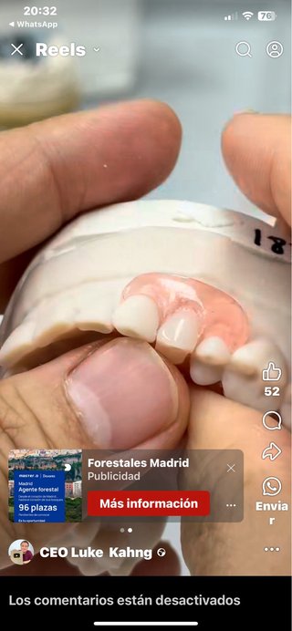 Prótesis dentales completas