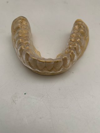 Prótesis dentales completas