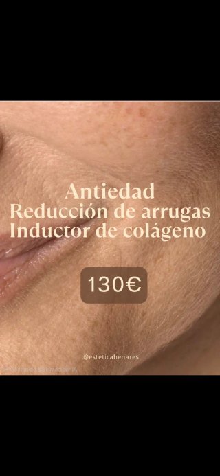 Tratamiento Antiedad e Inductor de Colágeno
