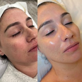 Limpieza faciales o peeling
